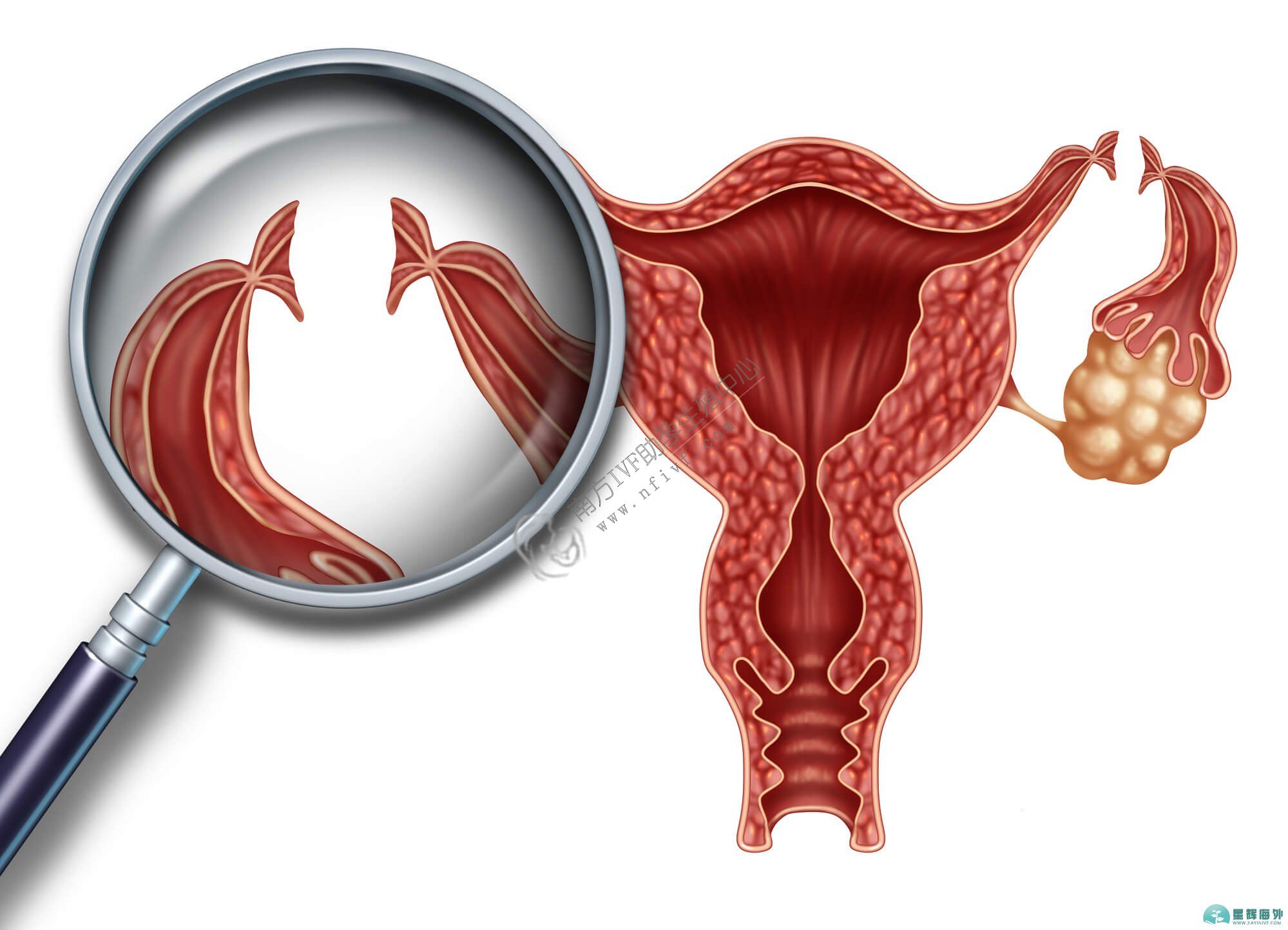 重庆40岁助孕产子医院排名:子宫内膜增生的症状是什么，该病有多严重？