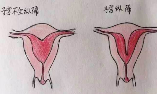 泰州供卵助孕哪家医院好-女性阴道纵隔的症